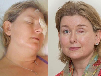 Cô Jacqueline Stone, 42 tuổi đã bị khoét bỏ mắt trái, 17 tuần nằm việc sau khi đeo kính áp tròng chỉ trong vòng một ngày.